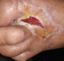 وکیوم تراپی زخم (NPWT) چیست؟ راهنمای کامل مراحل، هزینه و عوارض